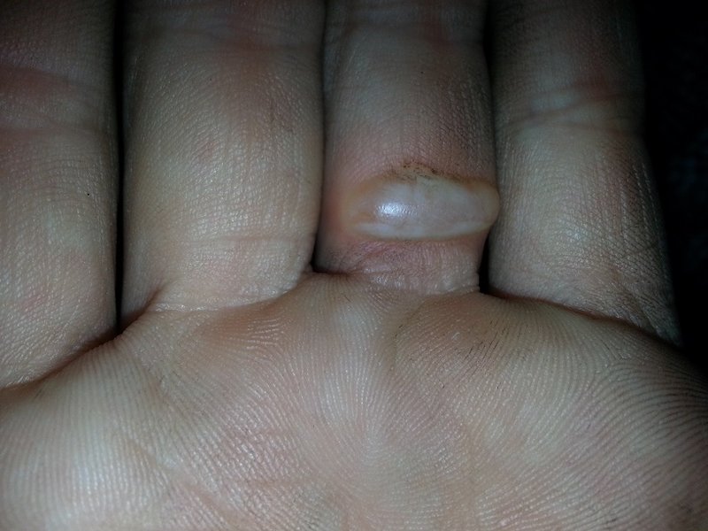 Fat blister on bottom where the arc occurred &amp; burned the fuck outta me!